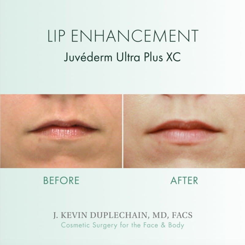 Before and after lip enhancement with dermal fillers by Dr. J. Kevin Duplechain in Lafayette, LA