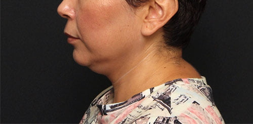 Neck Liposuction with Renuvion Case 27892