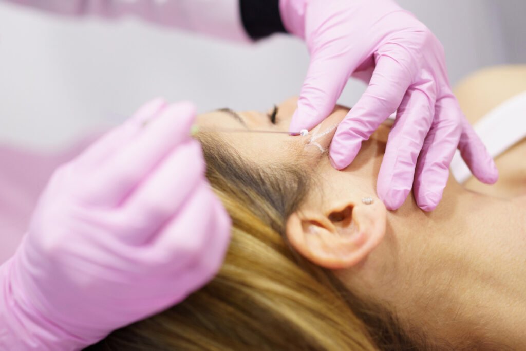 Woman undergoing a PDO thread lift procedure