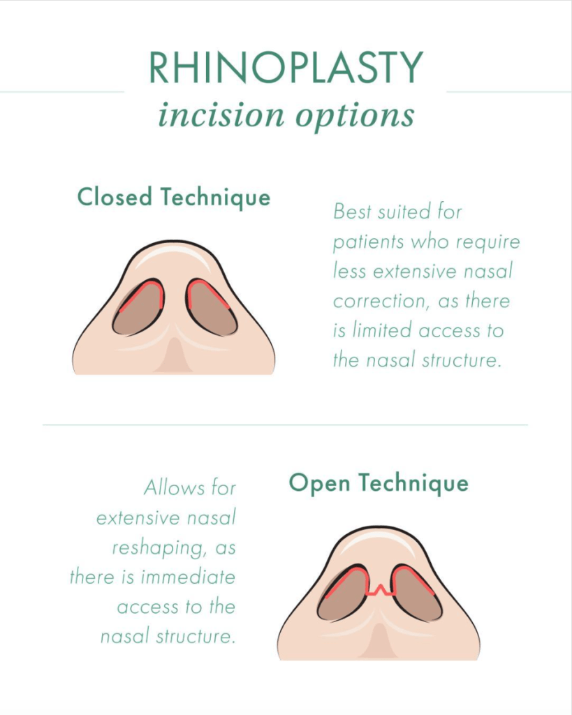 Infographic illustrating the incision options for open and closed rhinoplasty surgeries