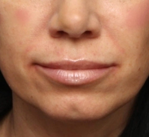 Lip Enhancement Case 27957