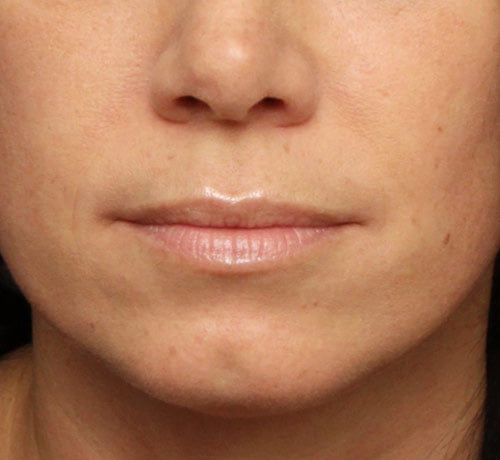 Lip Enhancement Case 27957