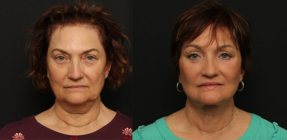 Female patient before and after Lafayette deep plane facelift with submental platysmaplasty, endoscopic brow lift, upper & lower blepharoplasty, fat transfer to perioral area & brow, and full face CO2 laser skin resurfacing.