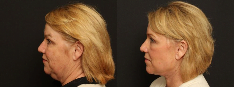 Profile view of female patient before and after Lafayette deep plane facelift, upper and lower eyelid surgery, brow lift, and CO2 laser skin resurfacing.