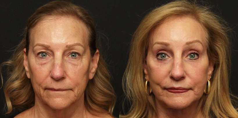 Female patient before and after Lafayette deep plane facelift, upper and lower eyelid surgery, brow lift, lip lift, chin augmentation, facial fat transfer and CO2 laser skin resurfacing.