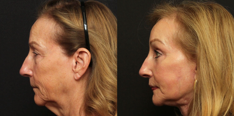 Side view of female patient before and after Lafayette deep plane facelift, upper and lower eyelid surgery, brow lift, lip lift, chin augmentation, facial fat transfer and CO2 laser skin resurfacing.