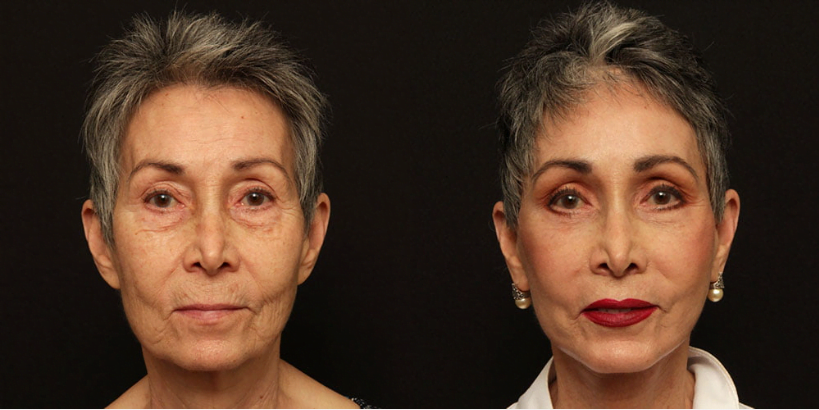 Female patient before and after Lafayette deep plane facelift, upper and lower eyelid surgery, brow lift, lip lift, chin augmentation, and CO2 laser skin resurfacing.