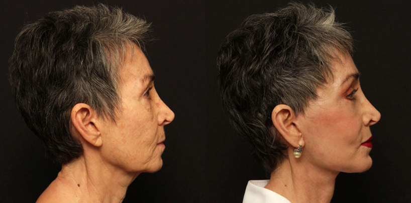 Side view of female patient before and after Lafayette deep plane facelift, upper and lower eyelid surgery, brow lift, lip lift, chin augmentation, and CO2 laser skin resurfacing.