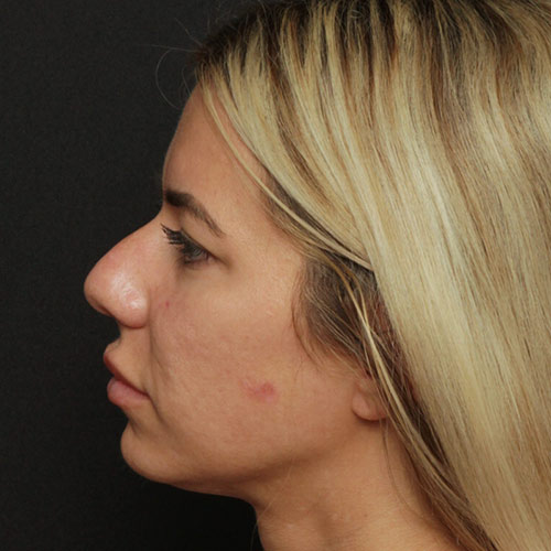 Rhinoplasty Case 28446