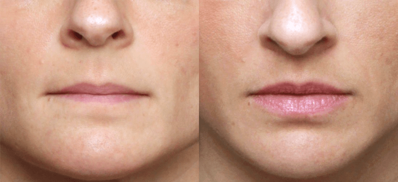 Before and after lip lift with lip fillers