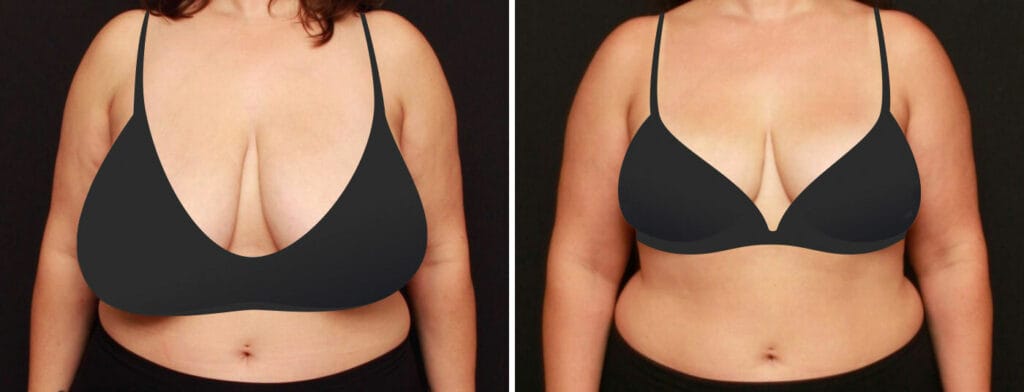 Before and after breast reduction and breast lift with Lafayette cosmetic surgeon Dr. Duplechain