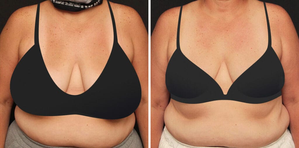 Before and after breast reduction and breast lift with Lafayette cosmetic surgeon Dr. Duplechain